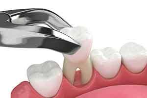 preliminary treatments such as tooth extractions may affect the cost of your dental implant treatment